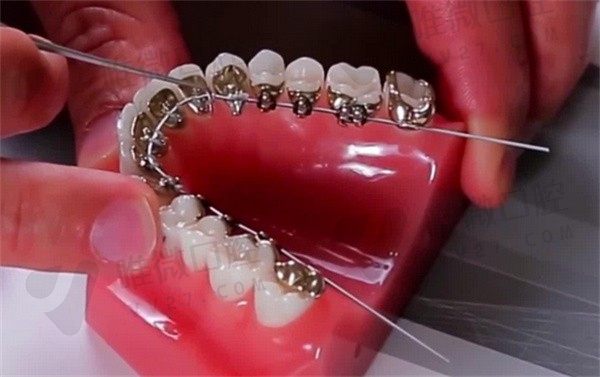 舌侧矫正适合哪种牙齿？骨性前突龅牙的情况做完脸型会变吗