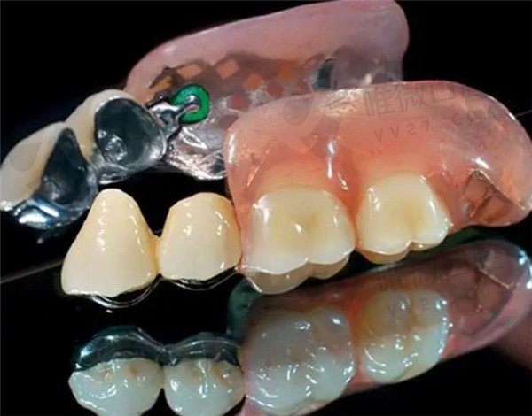 精密附着体义齿和种植牙哪种好？从两者的优缺点及价格来评判