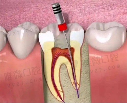 龋齿太深不痛为啥必须根管治疗？里面是坏死神经可以直接补牙吗
