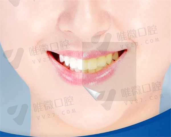 超声波洗牙对牙齿有害吗？想知道超声波洗牙和喷砂洗牙哪个好
