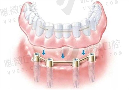 all-on-4种植牙是什么意思？有什么优缺点对医生技术要求高吗