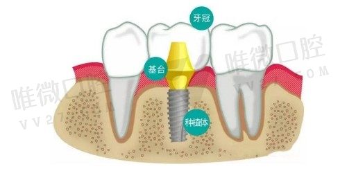 种植牙为什么要植骨?在线科普种植牙植骨和不植骨的区别就明白