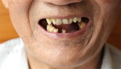 老人没牙齿了怎样固定假牙？看牙龈萎缩牙槽骨吸收后解决办法