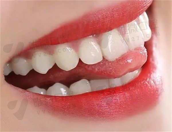 pola牙齿美白属于什么美白？谁来说下它和冷光美白有什么区别