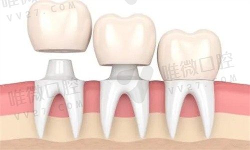 纯钛,钛合金,氧化锆三种牙冠哪个好？从性能/耐磨度来分析