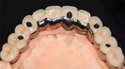 磁性固位体修复技术,20年不脱落,局部或全口缺牙都适用