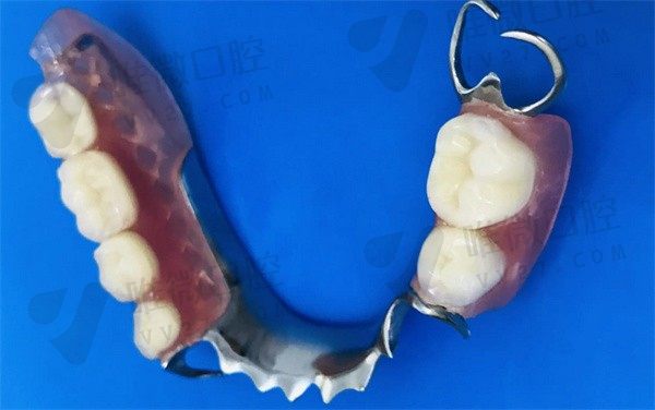 拔牙后多久能装假牙？可以马上装活动假牙或者过渡义齿吗