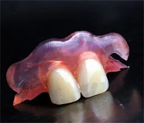 不伤邻牙的镶牙新方法：如果没钱种植牙那吸附性义齿也不错