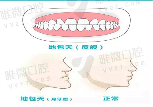 骨性反倾矫正手术一般费用多少？骨性反倾可以通过牙套矫正吗