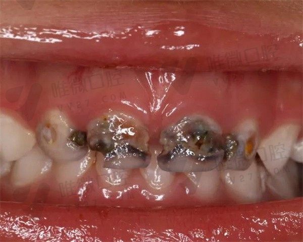 儿童牙齿发黑烂掉影响换牙吗？乳牙腐烂恒牙还能长吗还是说需要补