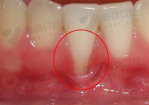 轻度牙周炎用做龈下刮治吗？如果不治疗会导致牙齿松动吗