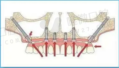 什么是穿颧骨种植牙？详解穿颧种植的含义/利弊/维持时间