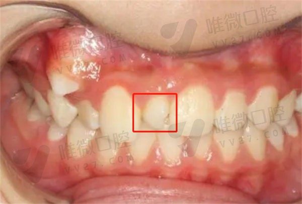 门牙中间多长了一颗牙齿怎么办？这颗多生牙拔掉后可以关闭缝隙吗