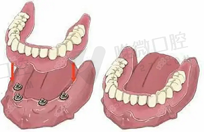 BPS吸附性义齿和普通义齿有啥区别?再看看BPS吸附性义齿的优缺点