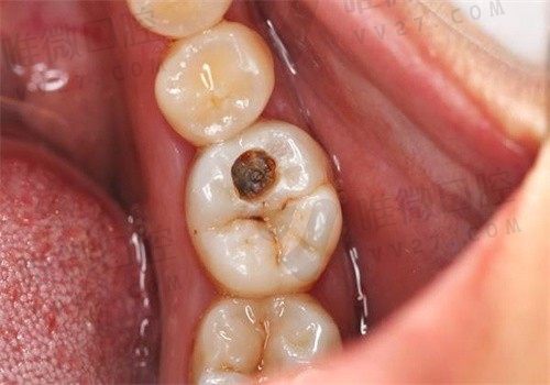 牙齿烂了个大窟窿怎么治？如何让蛀牙停止腐蚀？