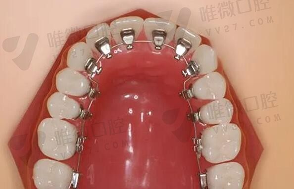 北京张栋梁教授牙齿矫正案例我有，我亲自做的舌侧正畸效果好极啦