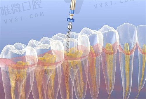 重庆牙齿根管治疗费用一般多少钱一颗?重庆根管治疗一颗牙价格500元起