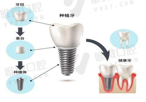 潍坊可恩口腔贺吉凯种牙价格729起，医生经验丰韩系植体性价比高