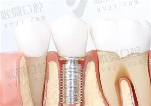 柏德口腔医院价格表公开，种牙3K正畸6K牙冠800根管治疗900起