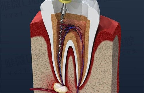 济南根管治疗多少钱一颗牙?推荐5家根管治疗便宜又好的口腔医院