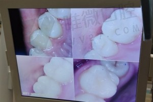 洗牙对比