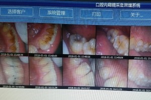洁牙对比