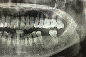 牙片