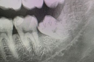 智齿牙片