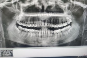 牙片