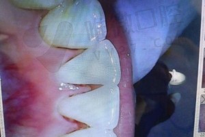 洁牙