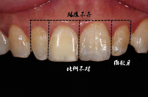 美学修复和补牙的区别是什么