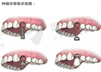 揭晓2023新政策下种牙的价格，看看是不是让你很心动