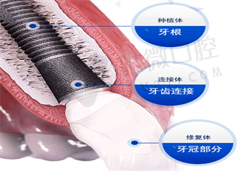 揭晓2023新政策下种牙的价格，看看是不是让你很心动