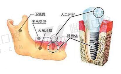 韩国奥齿泰植体好不好