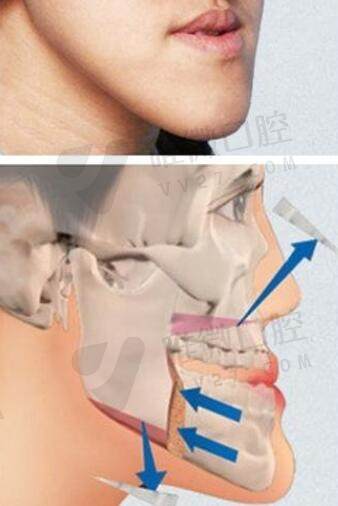 地包天做正颌手术后可改善