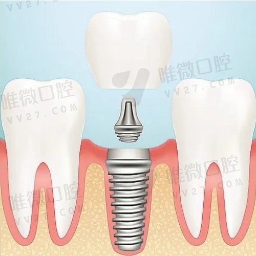 种植牙图解