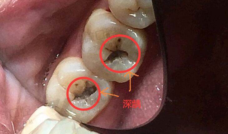 牙齿深龋齿的表现