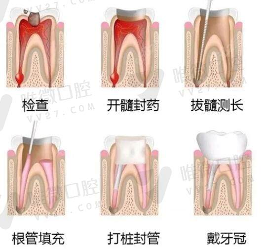 根管治疗的过程