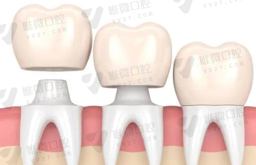 治疗牙齿缺失种植牙优势明显