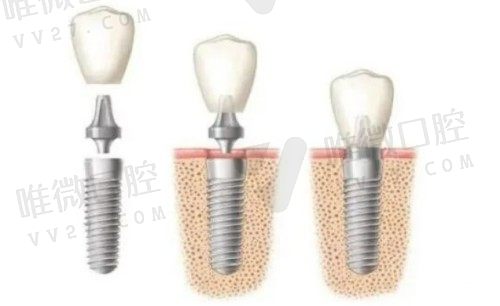 种植牙过程解析