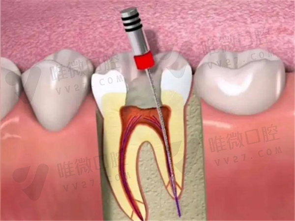 根管治疗