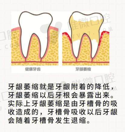 牙周刮治会不会造成牙龈萎缩