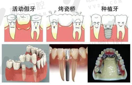 活动假牙和种植牙治疗的方式不同