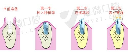 种植牙植入过程