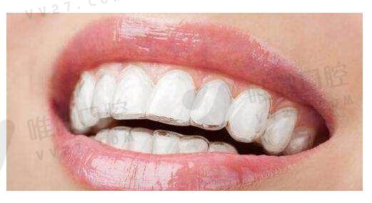 隐形牙套的优点和缺点及适应范围：