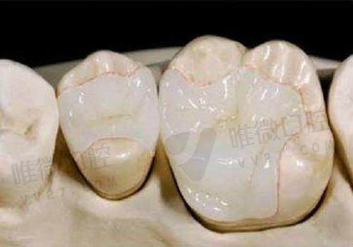 为什么牙医不建议补牙？