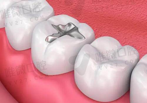 为什么牙医不建议补牙？