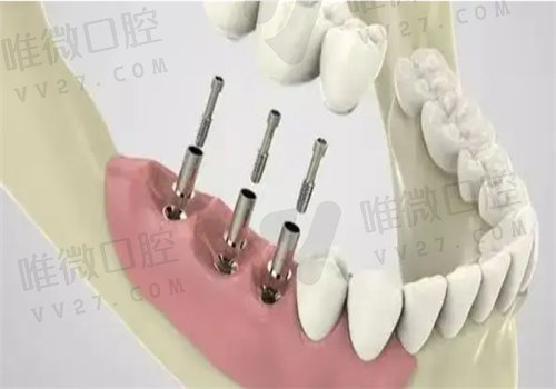 韩系种植牙有哪些品牌