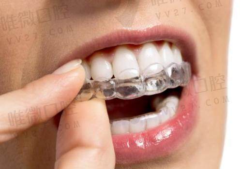 深圳同步齿科牙齿矫正怎么样？