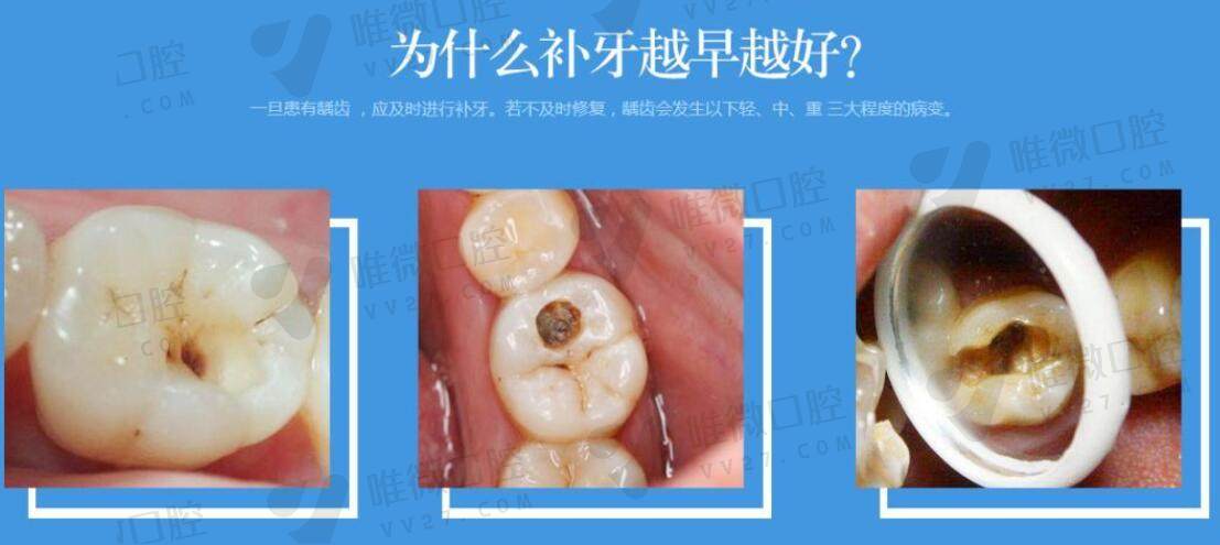 龋齿的分级浅、中级深龋